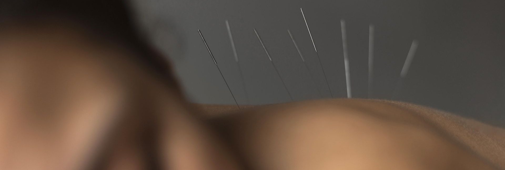 Akupunktura w Sopotorium